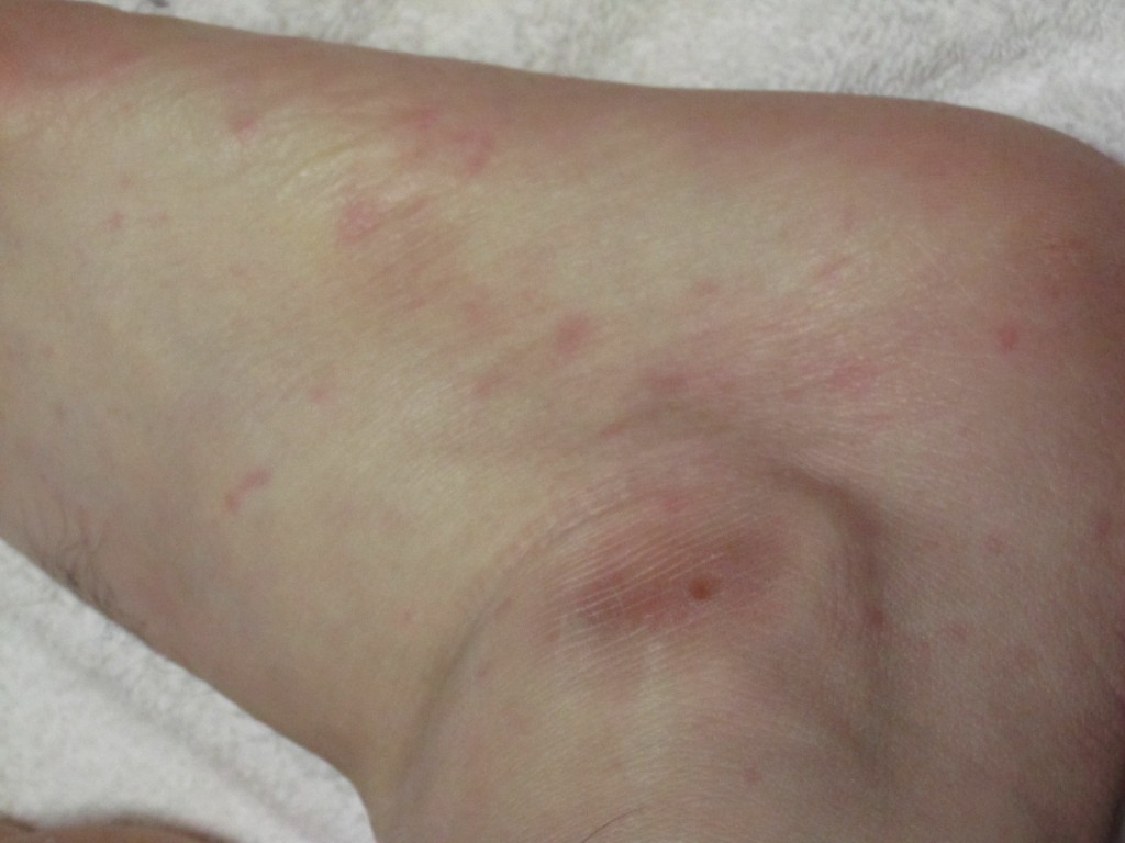 足の横・側面に赤い発疹・蕁麻疹が出た