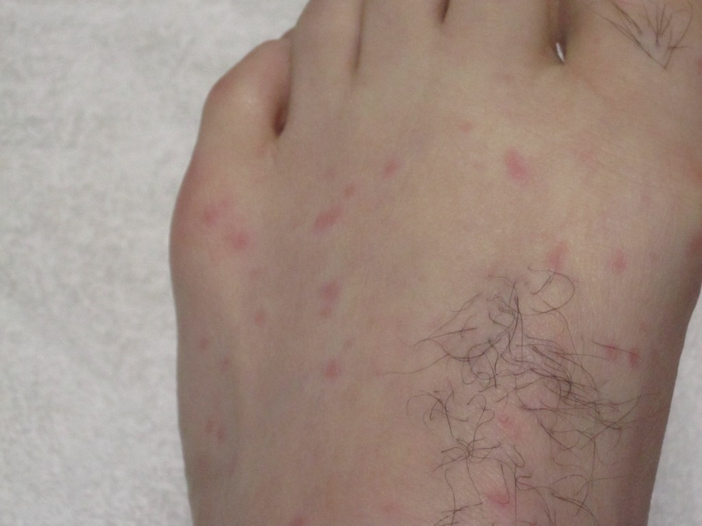 赤い蕁麻疹の周囲が白く変色している足の写真