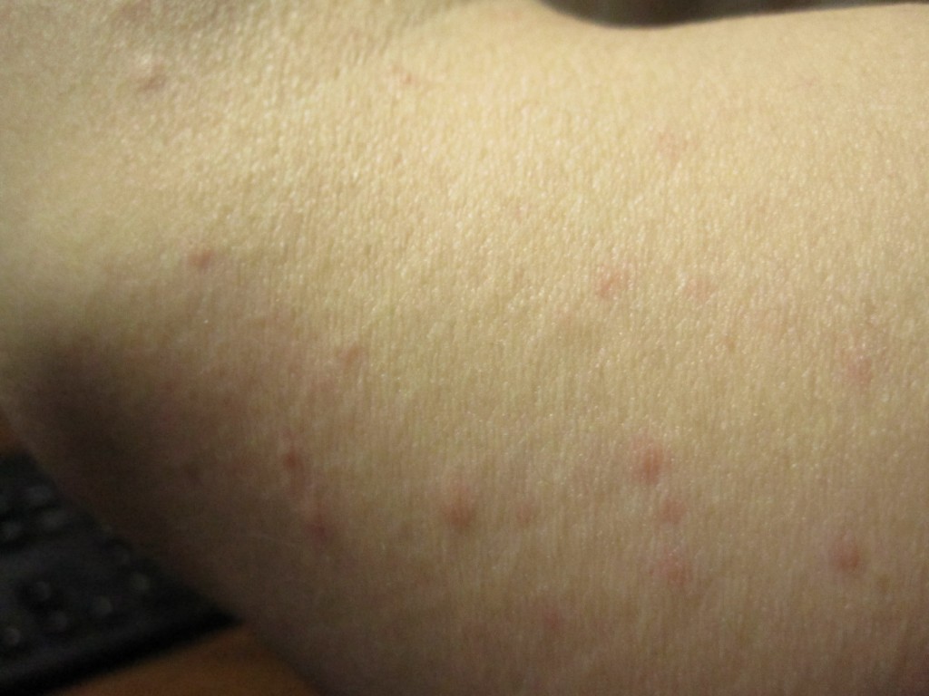 無色の膨疹状じんましんと、赤みを帯びた平たい蕁麻疹