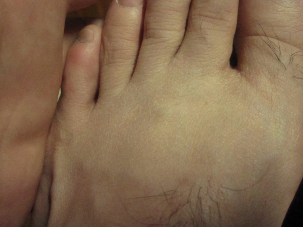 足の甲・指にもコリン性蕁麻疹は出ていない
