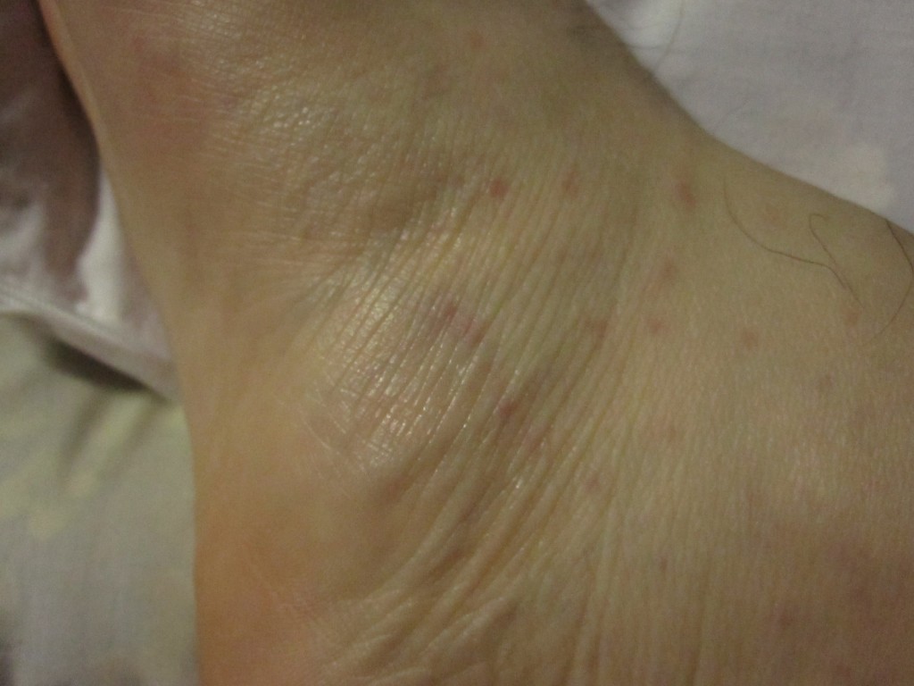 ポツポツと数カ所に蕁麻疹が発症した足側面