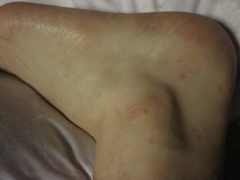 ポツポツと数カ所に蕁麻疹が発症した足・くるぶし
