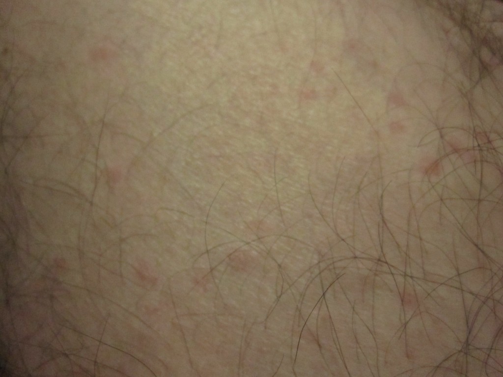 足首（くるぶし）の周囲にポツポツと出ている赤い蕁麻疹
