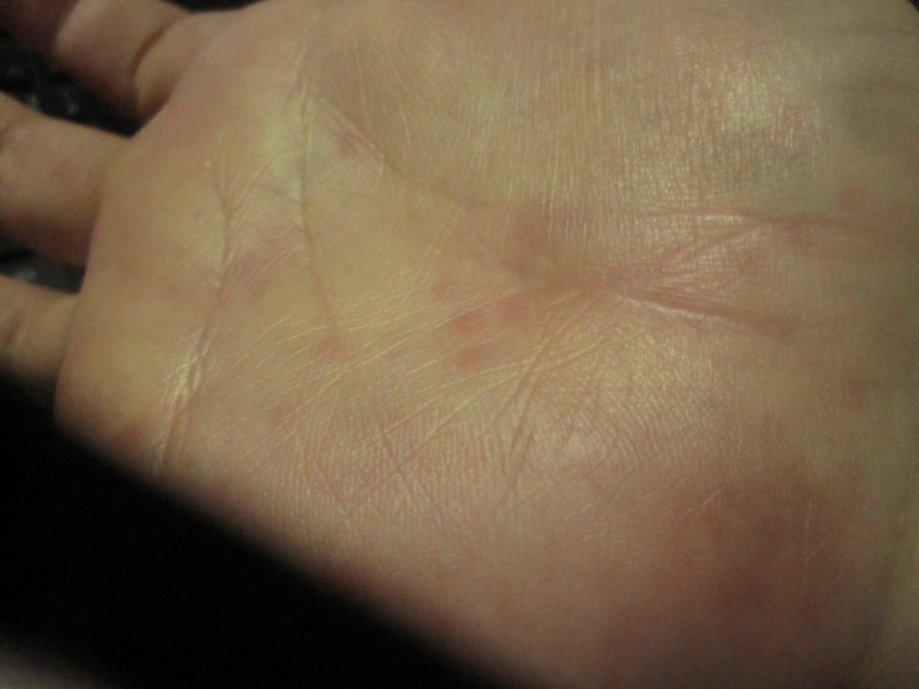 手の平にポツポツ・点々と出ている赤い蕁麻疹