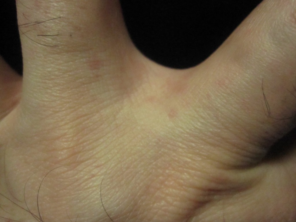指の付け根の水かき部分に赤い蕁麻疹を発見