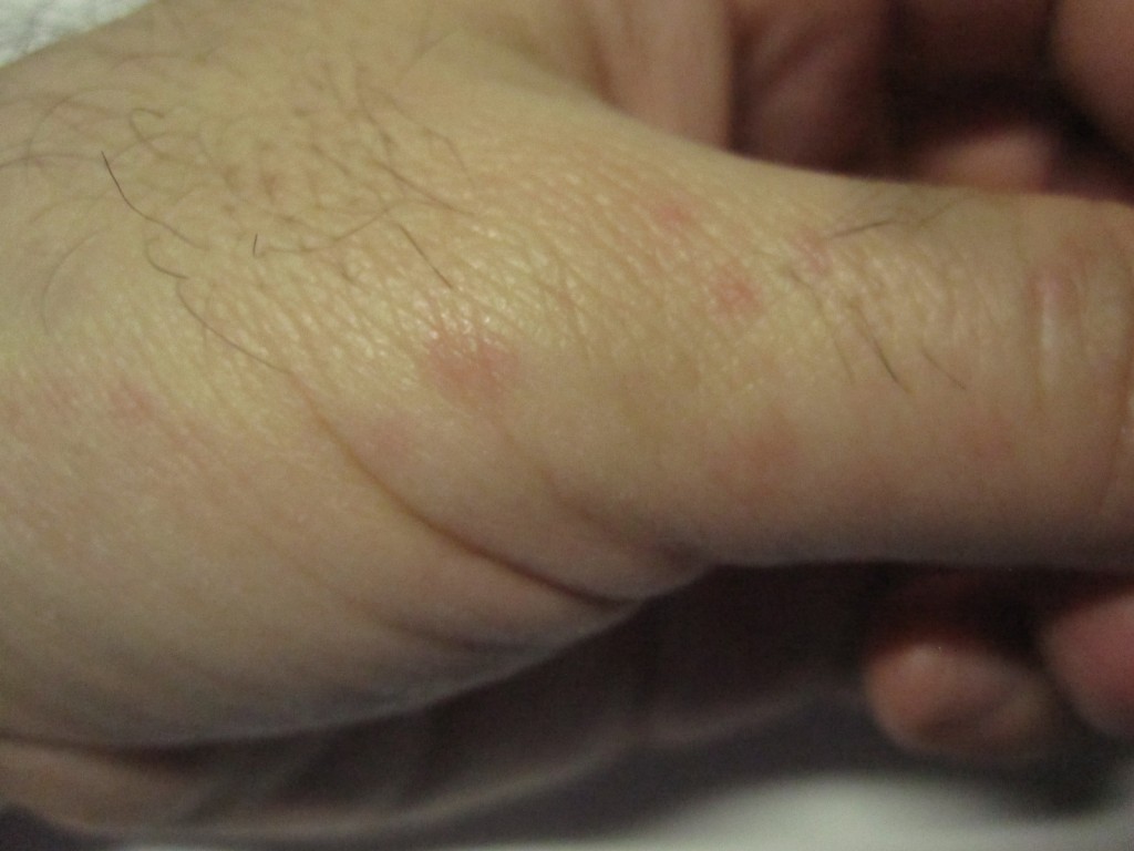 親指の付け根周辺に赤いコリン性蕁麻疹