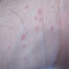 CALPIS（カルピス）アレルケアL-92乳酸菌がコリン性蕁麻疹の救世主となるのか期待してしまう自分がいる(;´Д｀)