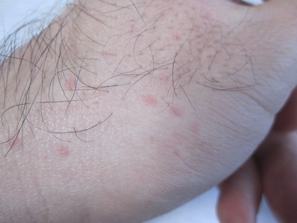 手の側面に赤くプツプツとしたコリン性蕁麻疹が出た