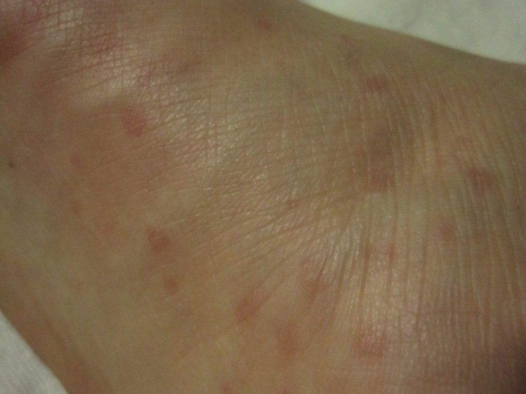 爪で掻いた直後の足の裏の赤い蕁麻疹