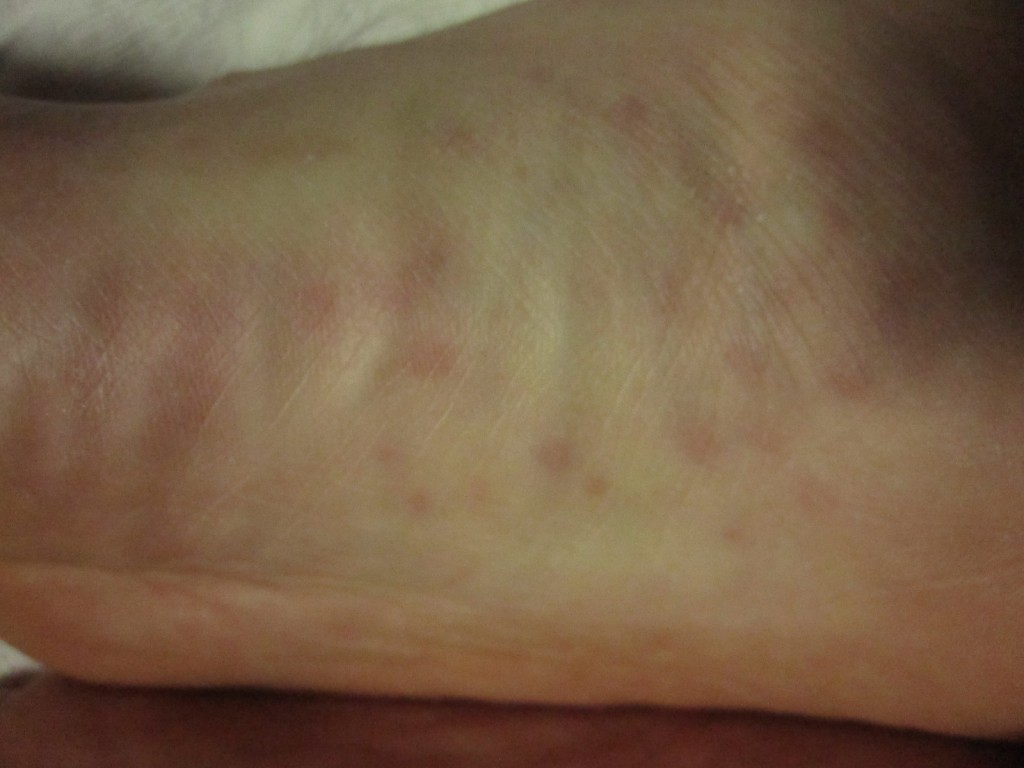 爪で掻いた直後の足の裏の赤い蕁麻疹