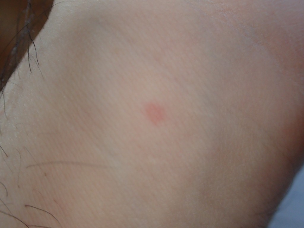 手首の内側に１つだけ出た赤い蕁麻疹（コリン性蕁麻疹？）