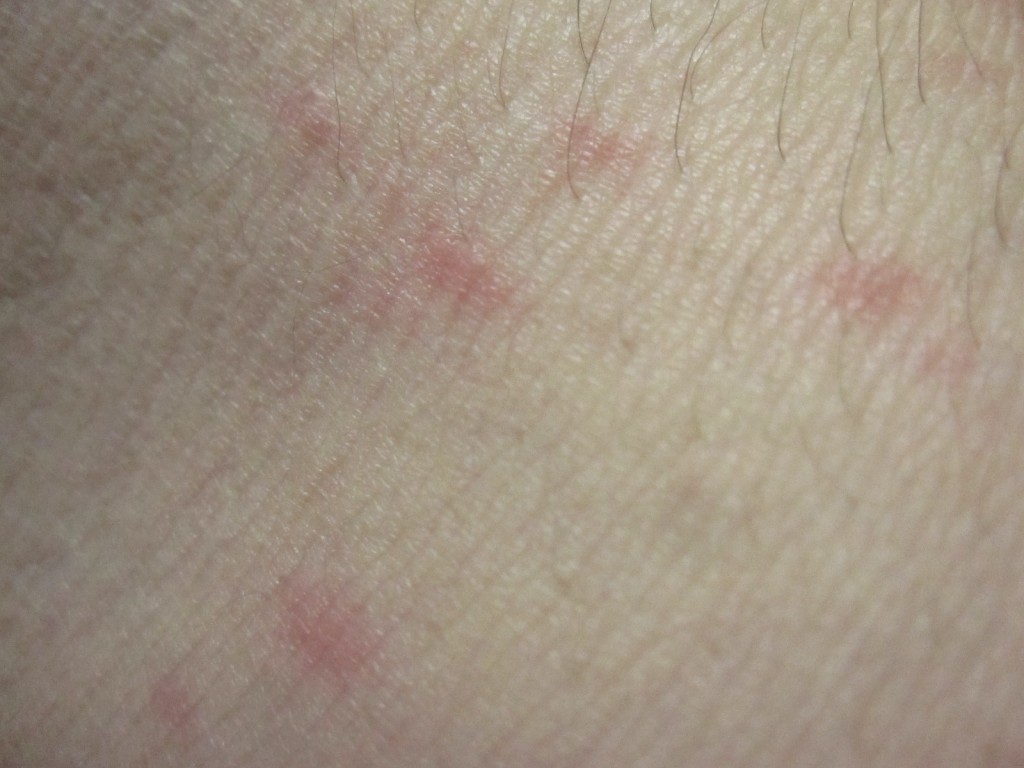 腕（肘の内側）に出た赤いコリン性蕁麻疹