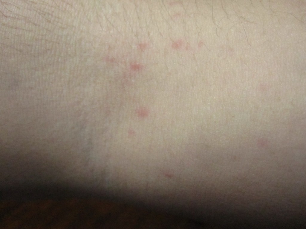 腕（肘の内側）に出た赤いコリン性蕁麻疹