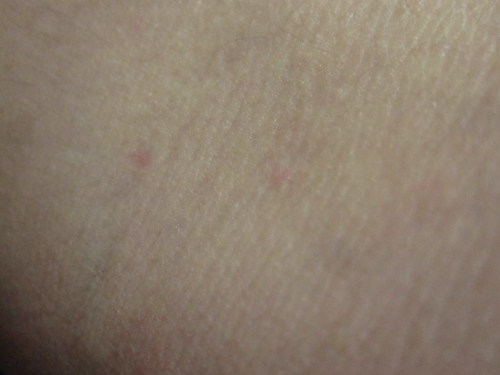 30分が経過した後の肌・皮膚は綺麗に蕁麻疹が消えている