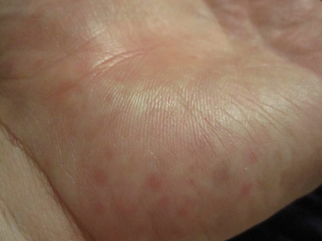 手の平に出てきた赤い発疹・コリン性蕁麻疹？