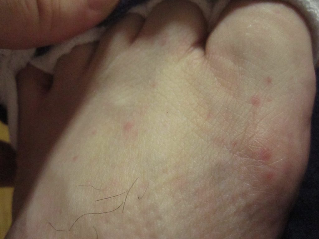 足の甲・指の付け根付近のコリン性蕁麻疹？