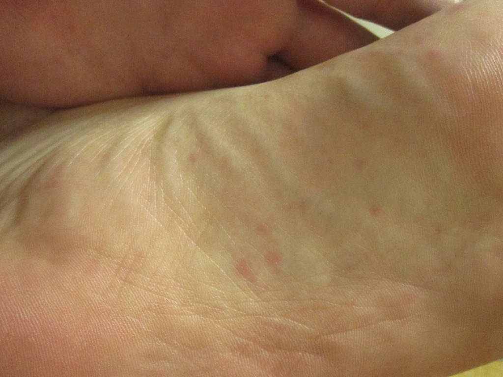 足の裏も手の平と同じく痒みの強い蕁麻疹