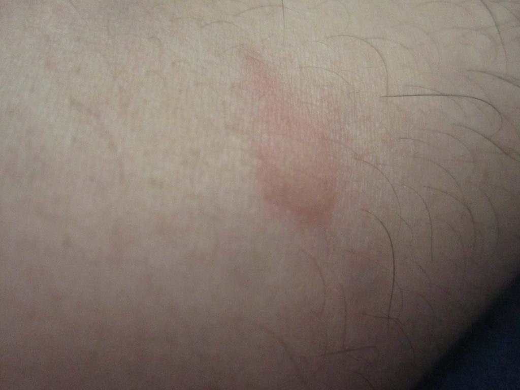 害虫のヤブ蚊に刺されて赤く膨らんだ皮膚の状態