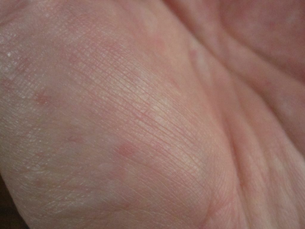 手の平の赤い蕁麻疹をデジタルカメラで接写撮影した画像