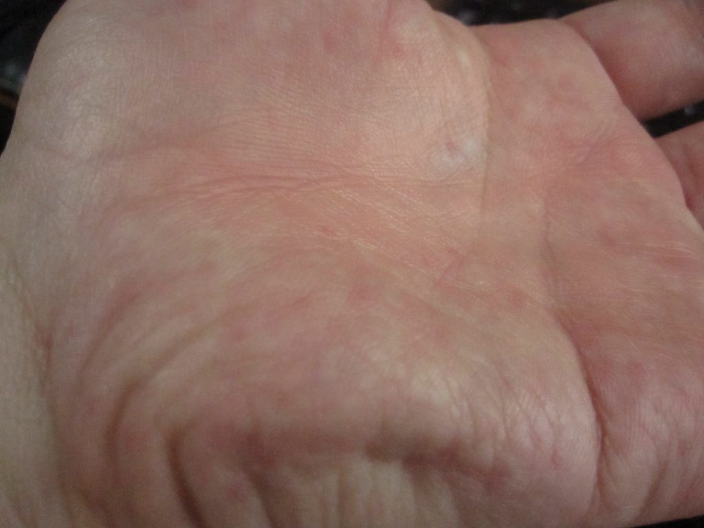 手の平に赤くて痒いコリン性蕁麻疹が出た時の撮影写真