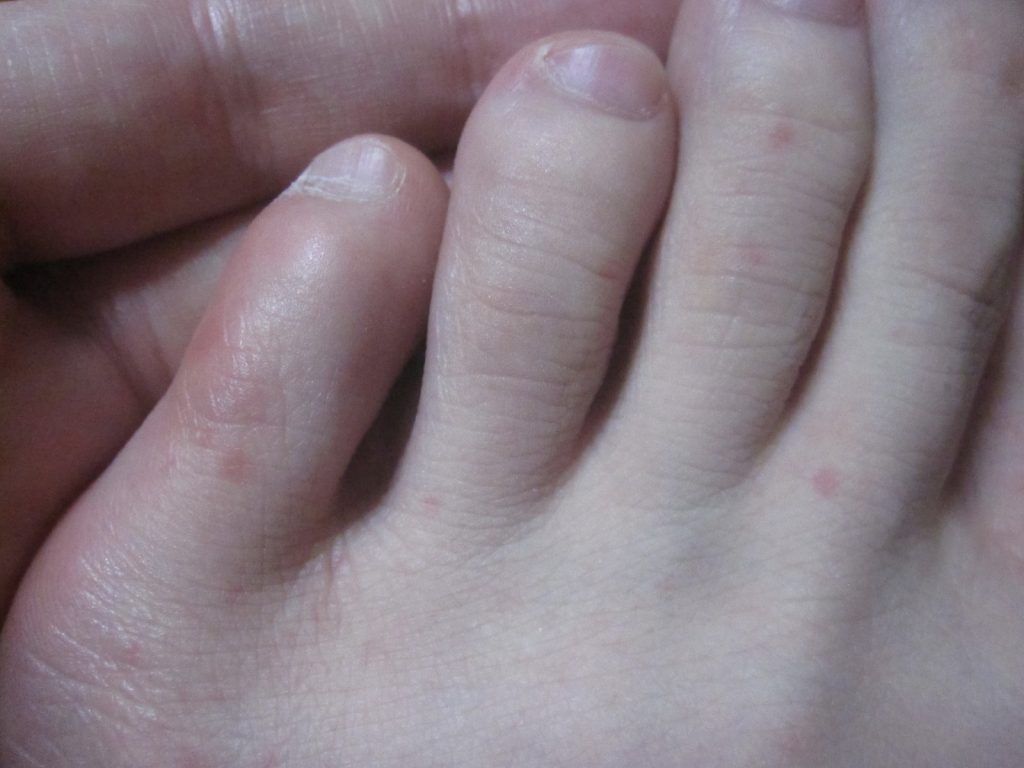 足の指・甲に出た赤くて痒い発疹（コリン性蕁麻疹？）
