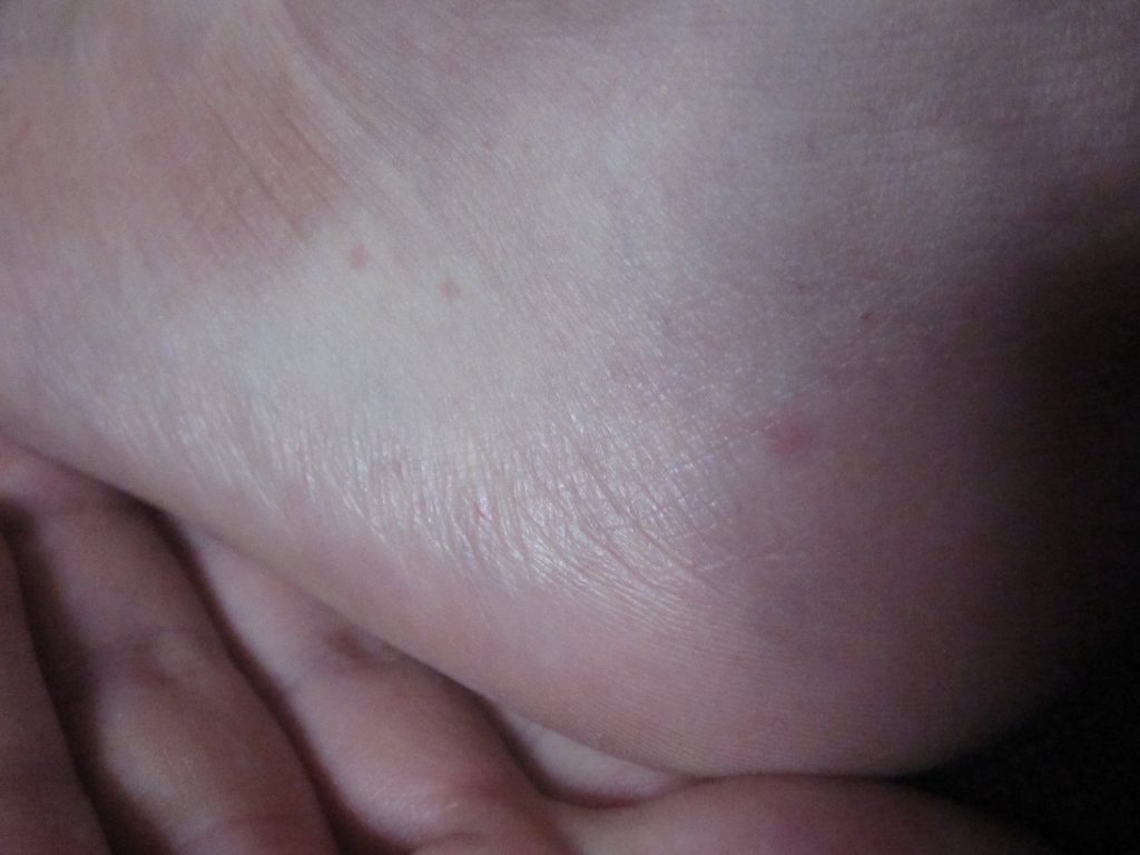 足のかかと付近に数点の赤いコリン性蕁麻疹が出た写真