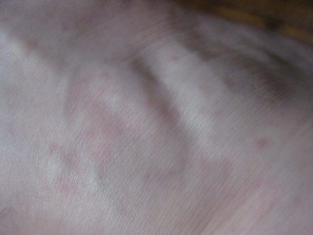 手首に出てきたコリン性蕁麻疹の写真