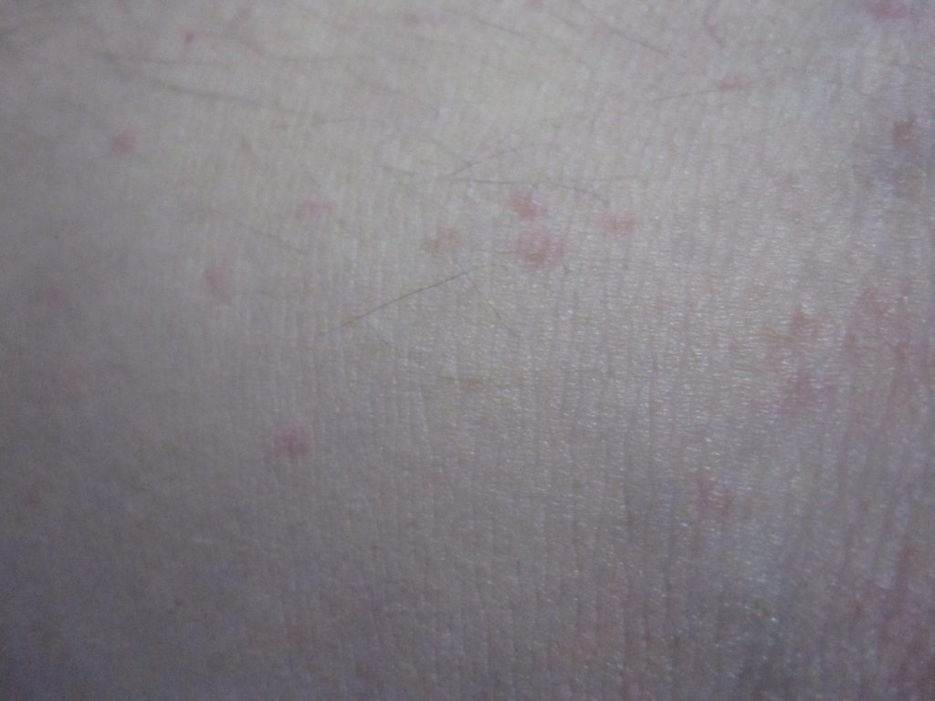 二の腕にちょっとだけ出現したコリン性蕁麻疹