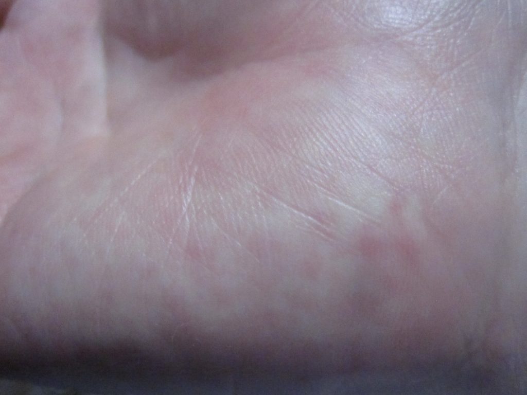 手のひらに赤いポツポツの蕁麻疹が出た状態の写真