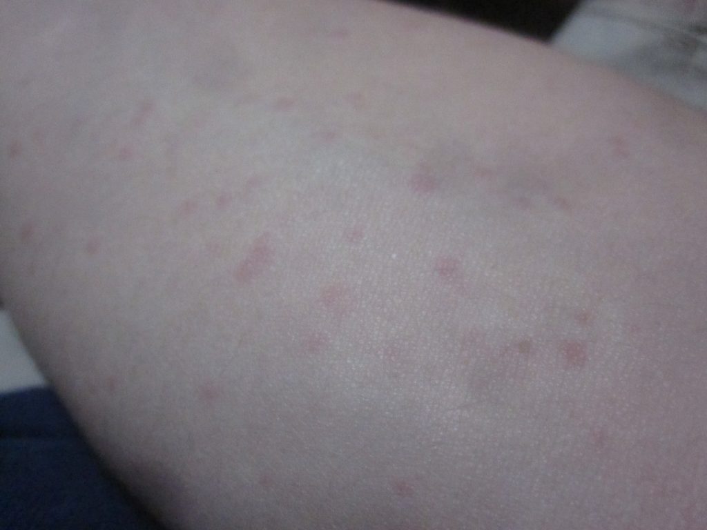 腕に出現した赤い発疹はコリン性蕁麻疹なのか！？