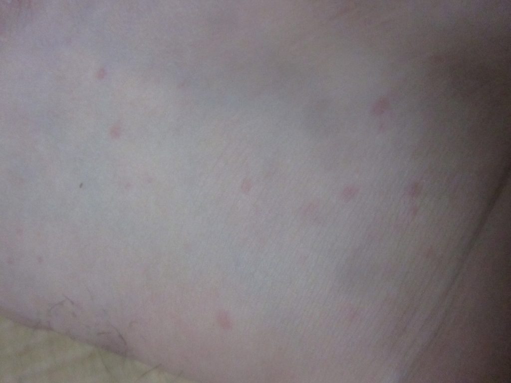赤くてチクチク痛かゆいコリン性蕁麻疹？