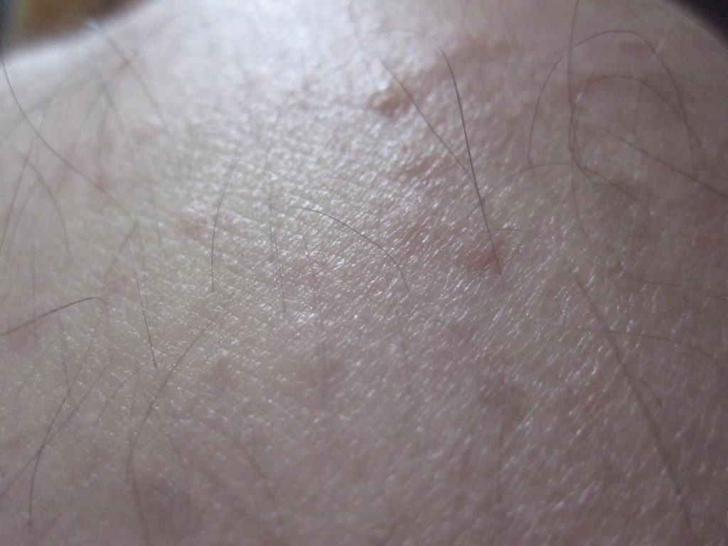 膝の周囲に蚊に刺された時のような膨疹じんましんが大発生！痒くてチクチク痛い！