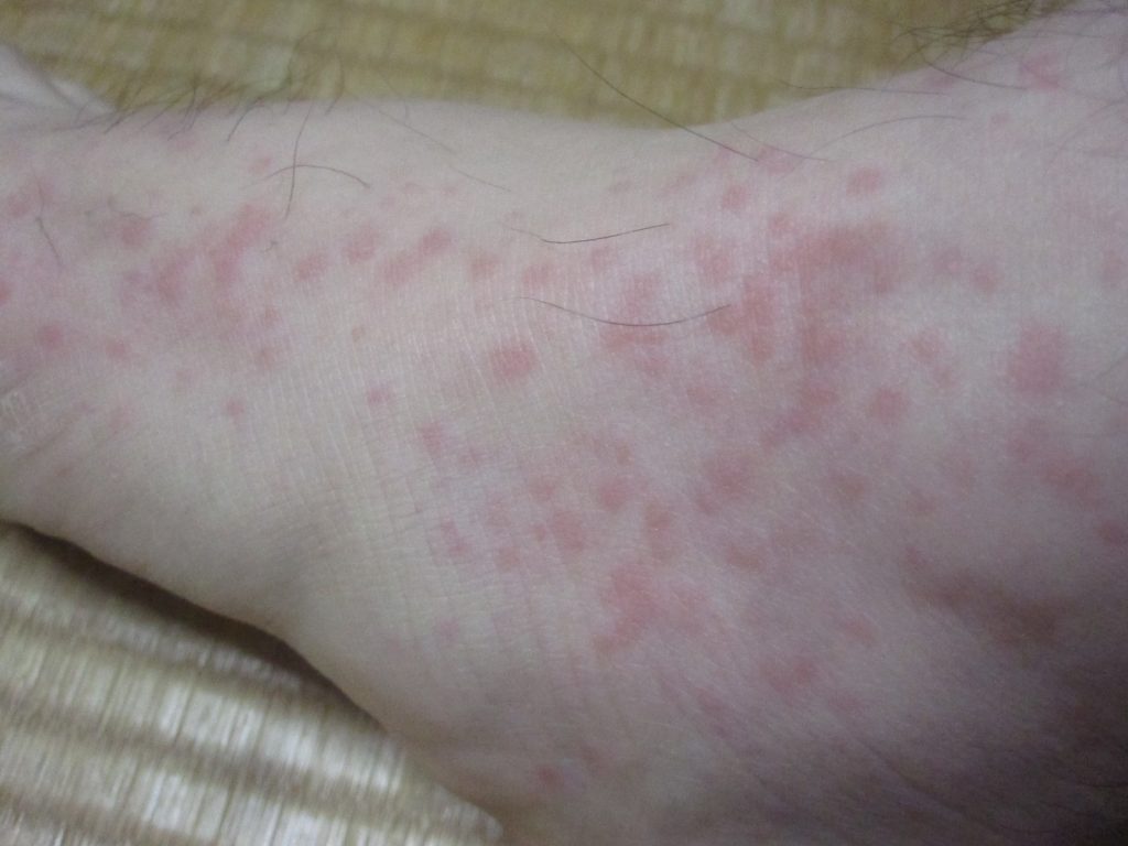 右足に大量発生した赤い”発疹”・”じんましん”の写真