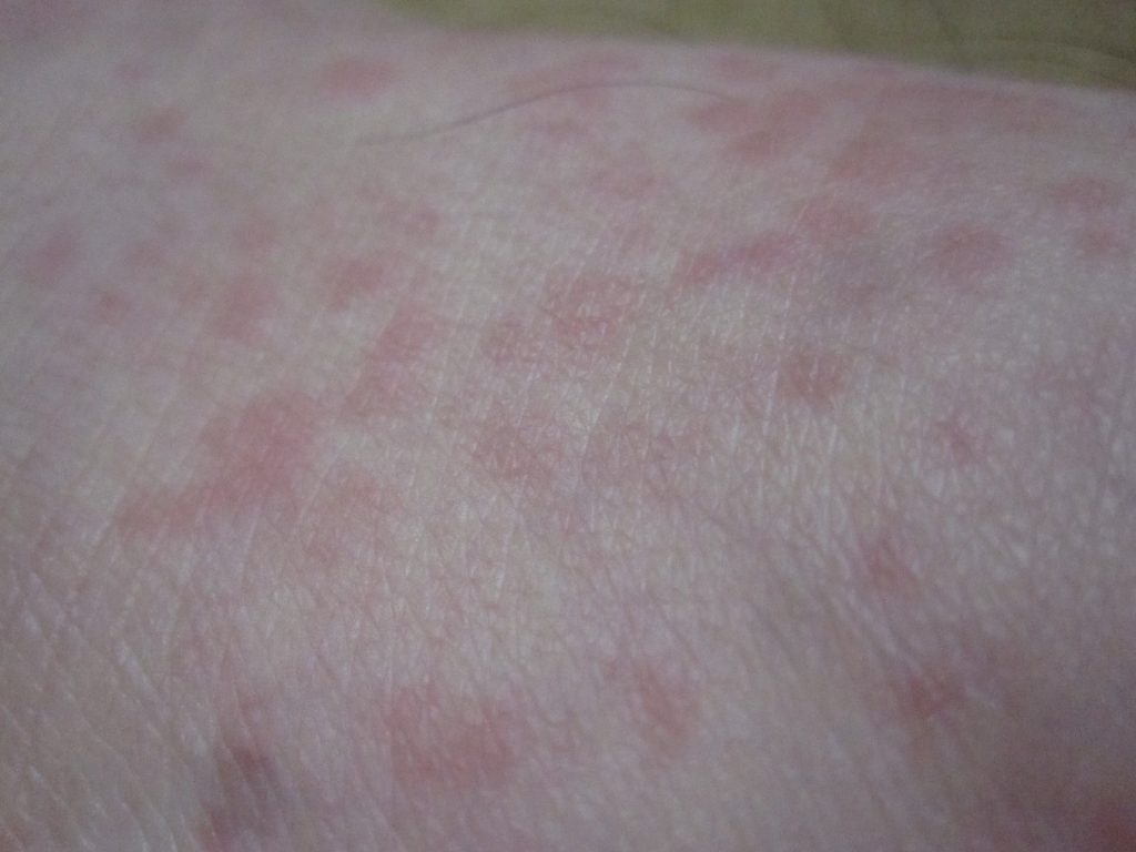 右足に大量発生した赤い”発疹”・”じんましん”の写真
