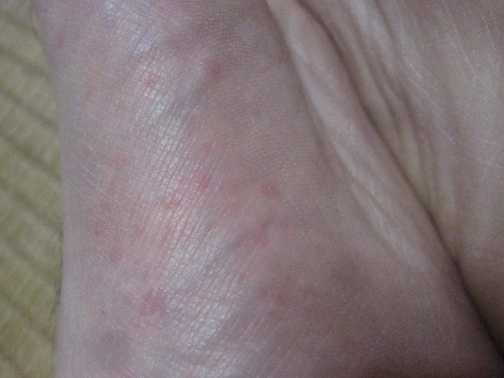 左足の裏にまで出てきているコリン性蕁麻疹の写真