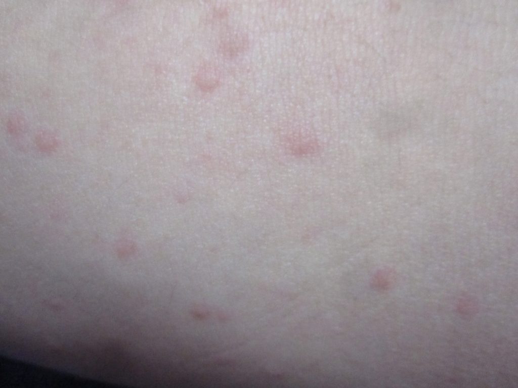 腕にも赤く膨らんだ膨疹状のコリン性蕁麻疹が勃発！