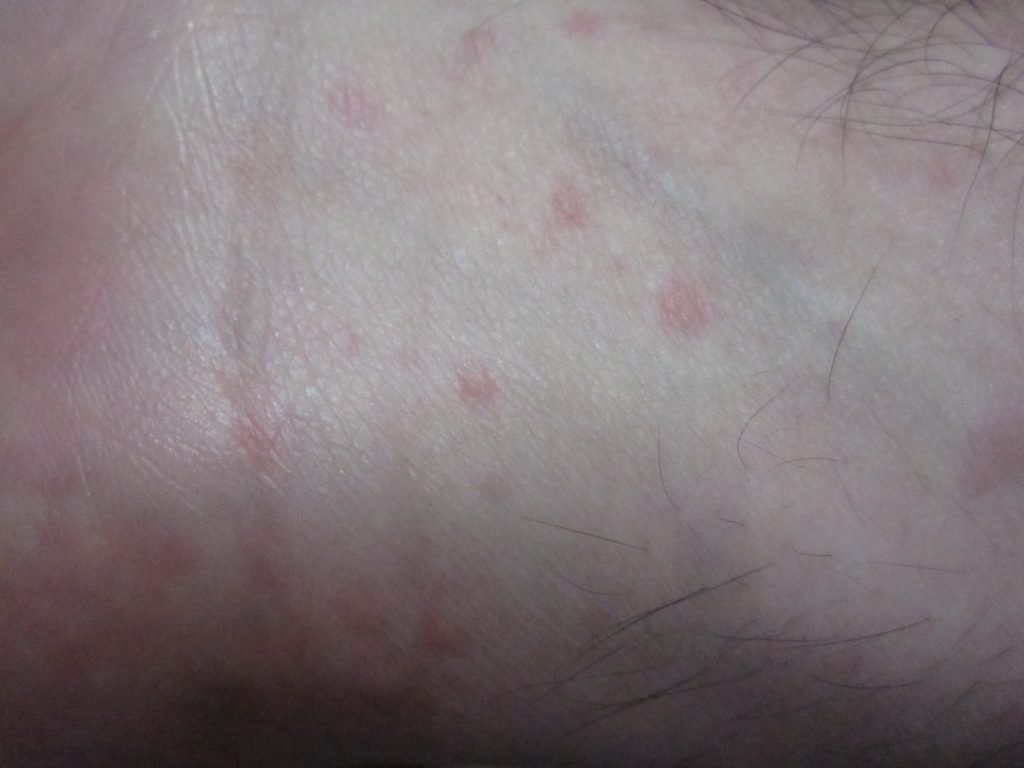 手首の内側に赤くポツポツと出現した蕁麻疹