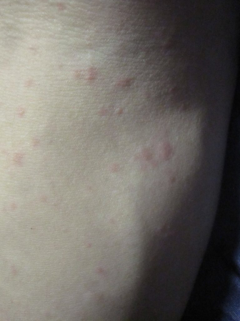痒くて赤いポツポツ蕁麻疹の症状が現れた腕の写真