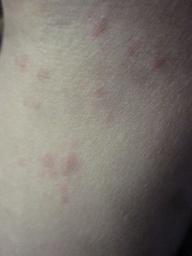 痒くて赤いポツポツ蕁麻疹の症状が現れた腕の写真