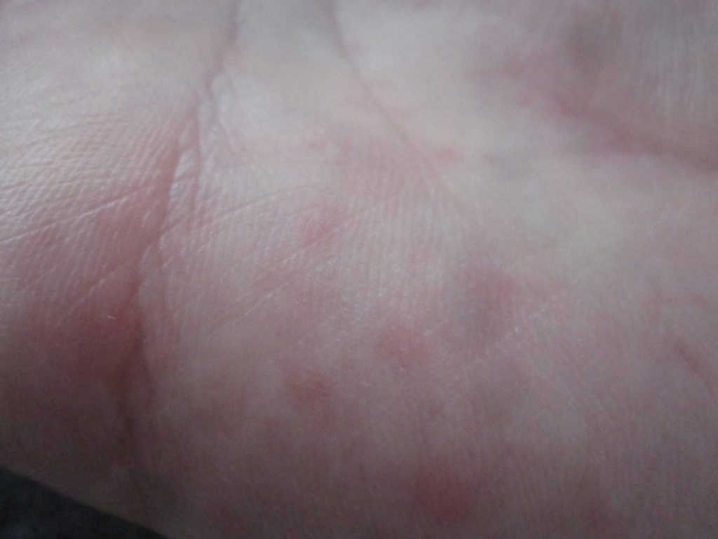 手の平に出るコリン性蕁麻疹が特に痒みが強い