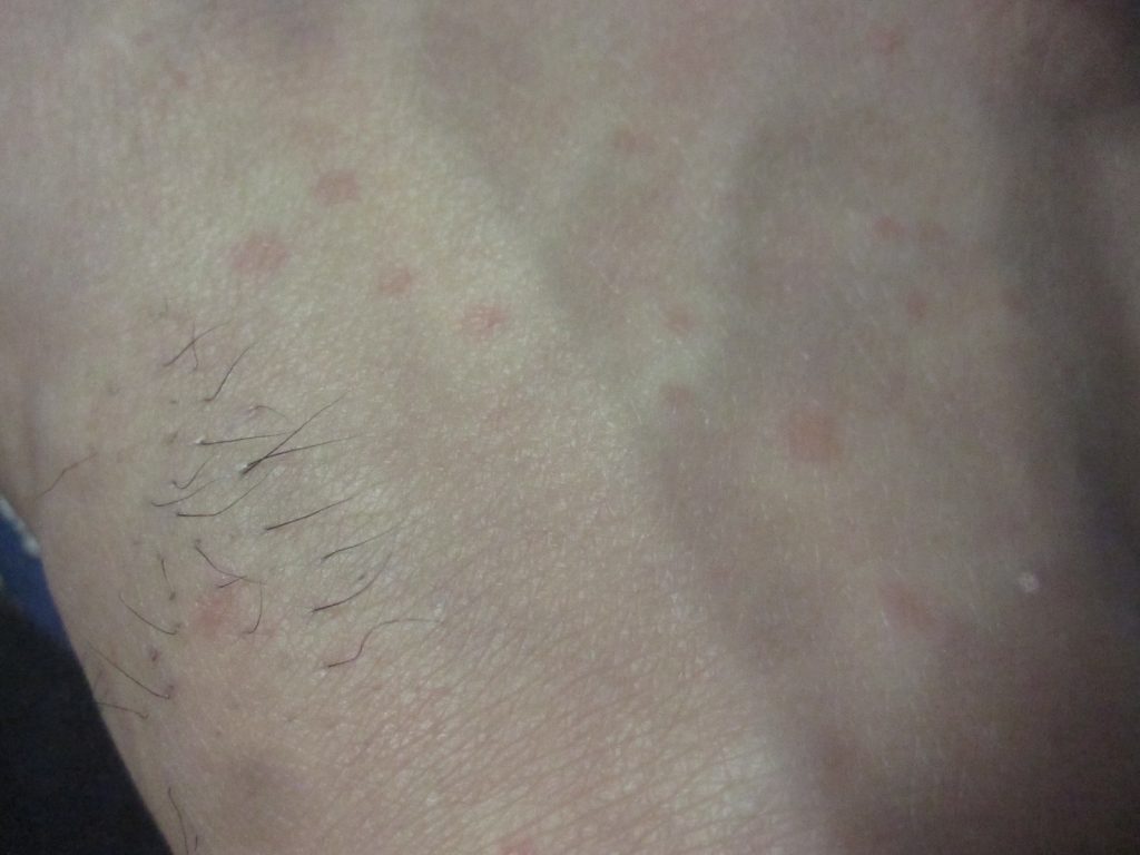 足の甲に出てきたコリン性蕁麻疹を撮影した画像