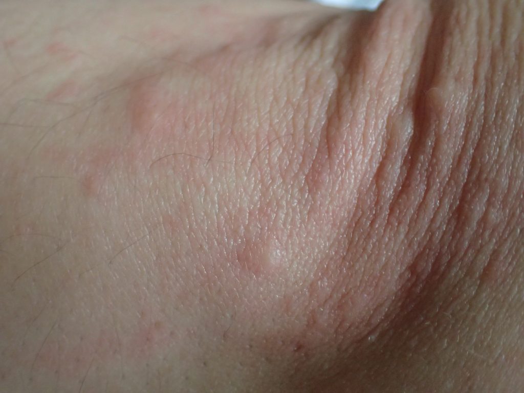 コリン性蕁麻疹とは違う感触と痒みをもったブツブツ凹凸