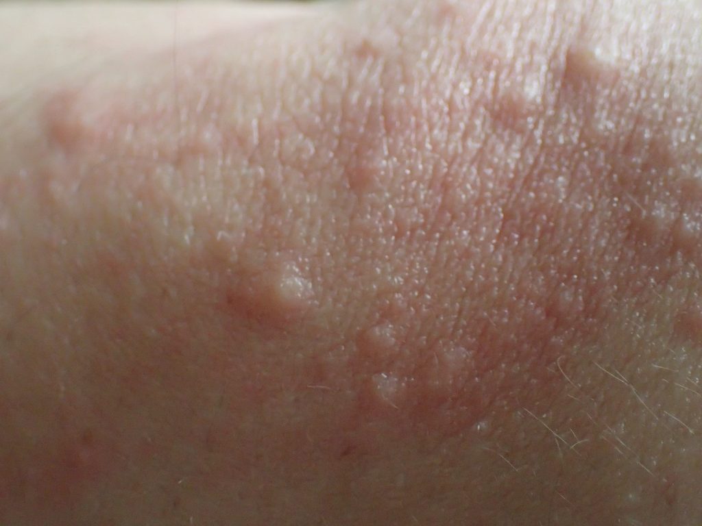 コリン性蕁麻疹とは違う感触と痒みをもったブツブツ凹凸