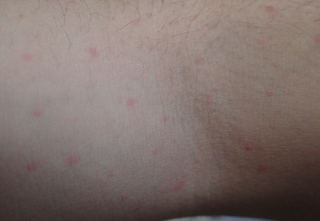 腕に出ている赤い発疹・蕁麻疹（じんましん）