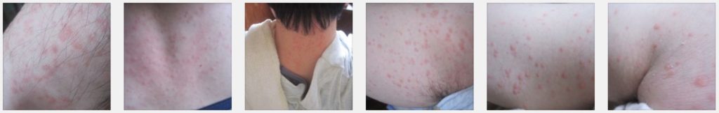 以前に、全身に蕁麻疹が出た状態の写真