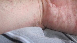 手首から手の平にかけて出現した蕁麻疹