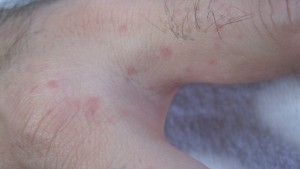 指と指の間の水かき部分にも蕁麻疹が発生する