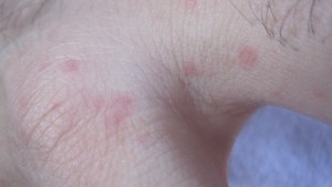 指と指の間の水かき部分にも蕁麻疹が発生している