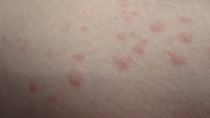 皮膚・肌の痒さと見た目の気持ち悪さが悩みのコリン性蕁麻疹