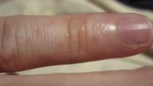 手の指にできた赤い発疹・湿疹は温熱性蕁麻疹なのか？